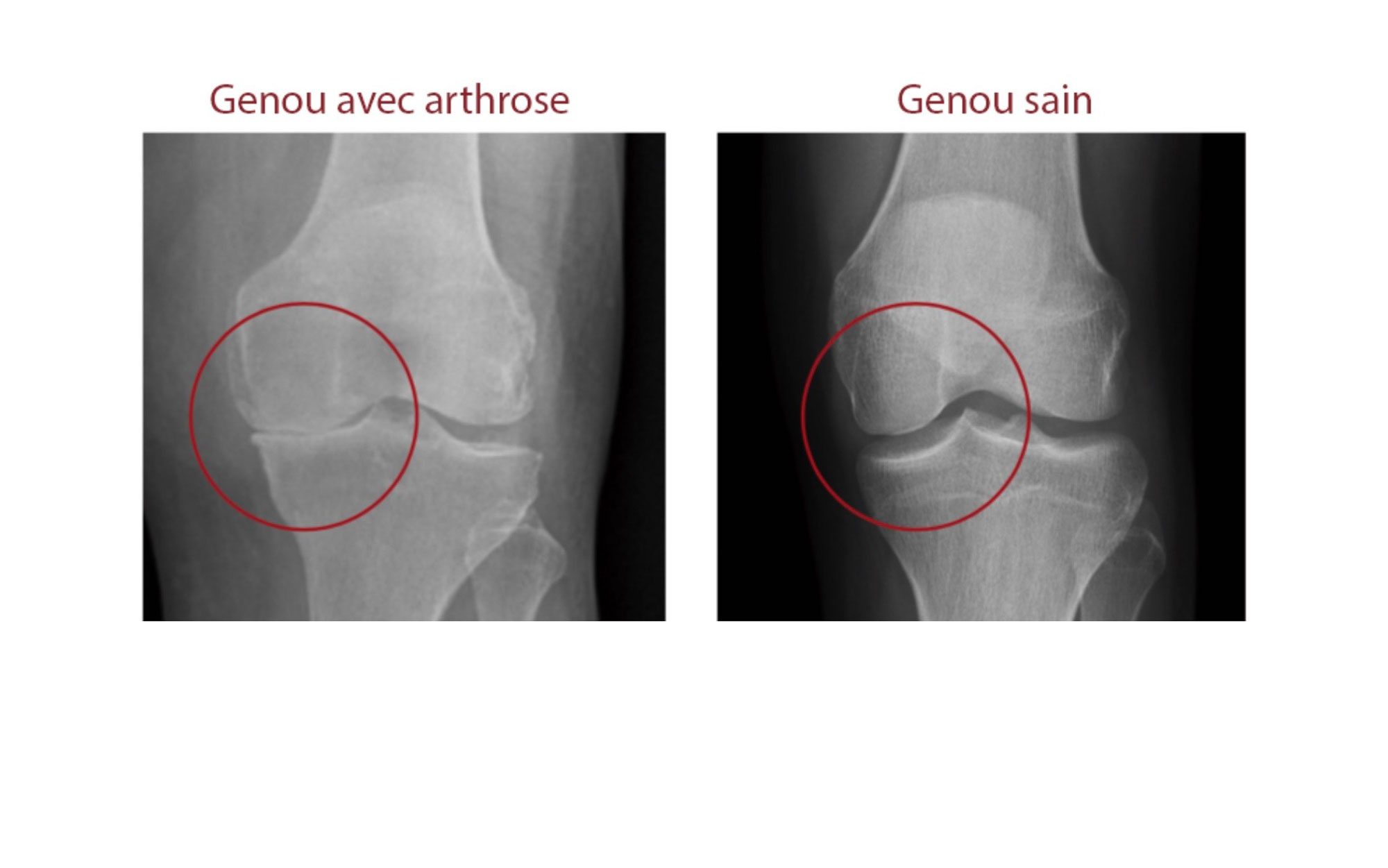 L'arthrose du genou ou la gonarthrose - Clinique du genou